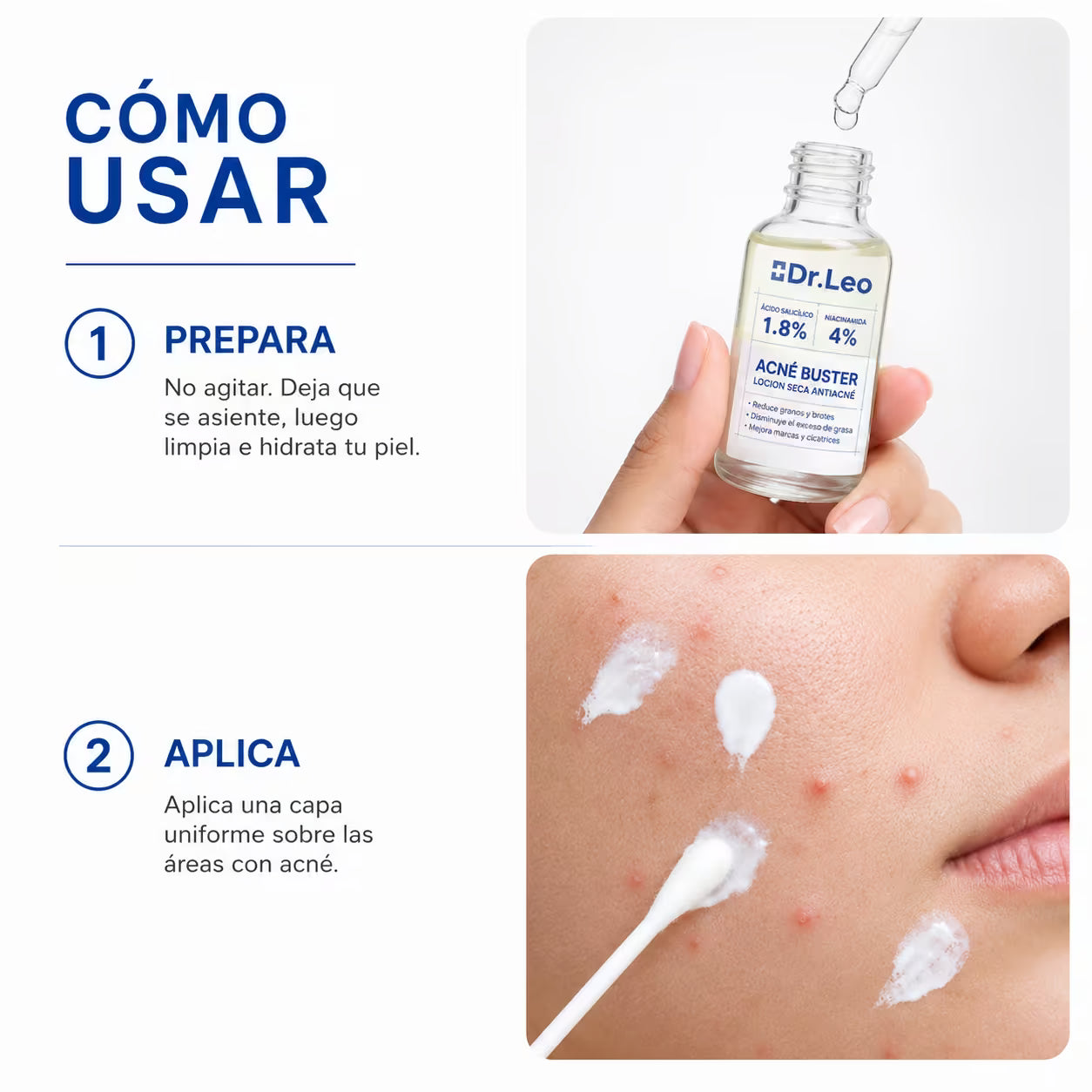 Tratamiento Acné Buster - Combate brotes, espinillas, granos y todo tipo de acné - 20 mL