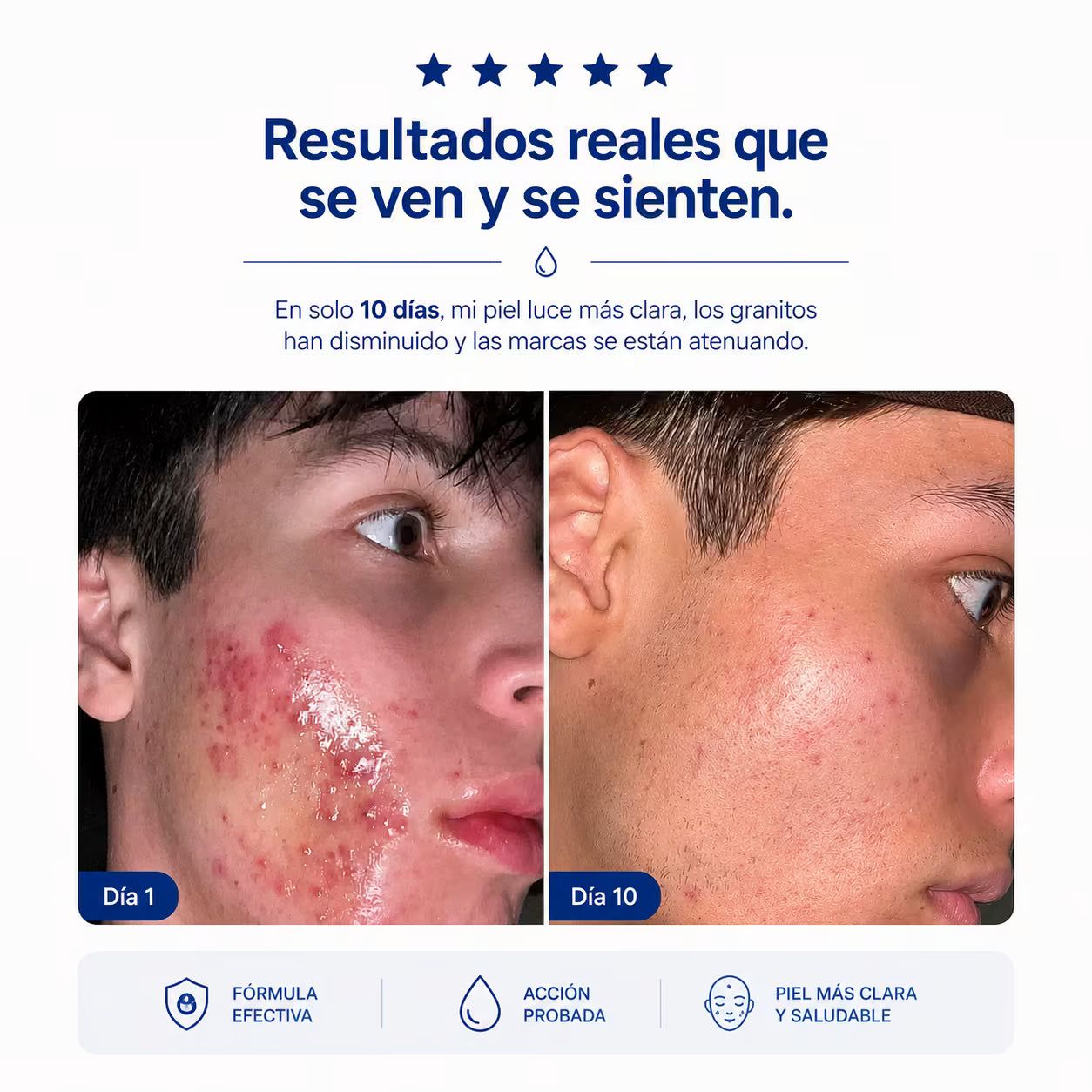 Tratamiento Acné Buster - Combate brotes, espinillas, granos y todo tipo de acné - 20 mL